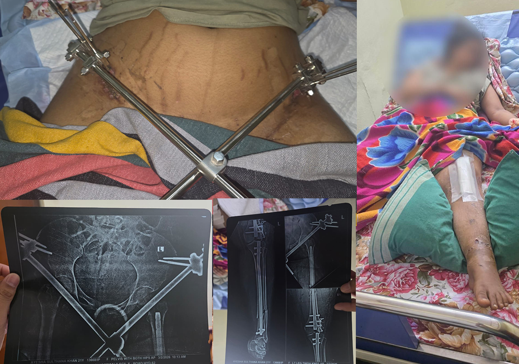21-Year-Old Ayesha Is Fighting to Walk Again
